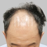 台北植髮,新竹植髮,台中植髮推薦-毛囊已經壞死-H&H醫髮診所