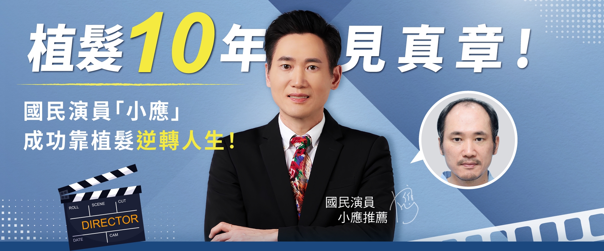 植髮存活率95%！國民演員「小應」實證，植髮10年效果公開！