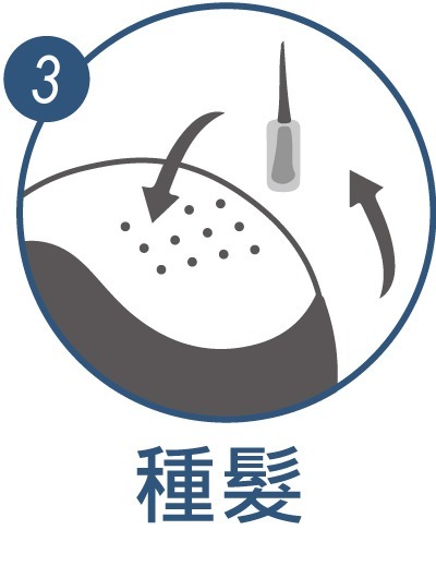 植髮方式v2icon03