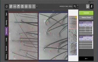 頭皮檢測/檢查_直徑分析_醫髮診所