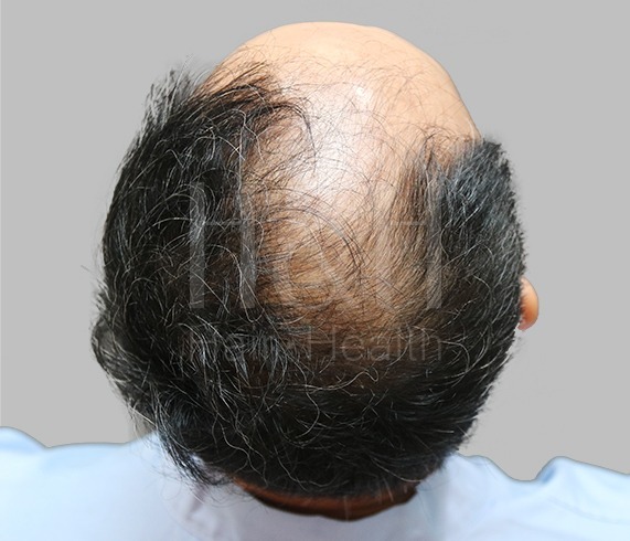 頭髮稀疏_植髮手術見證案例_HH醫髮1