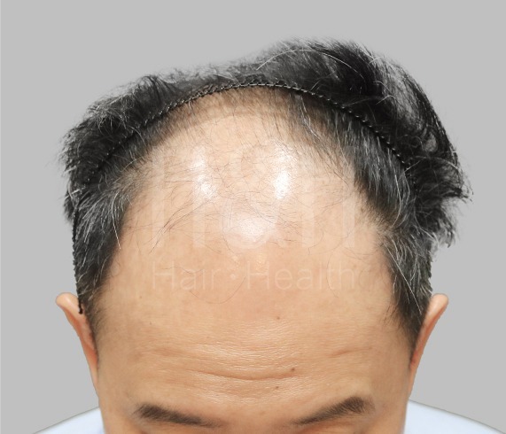 頭髮稀疏_植髮手術見證案例_HH醫髮3