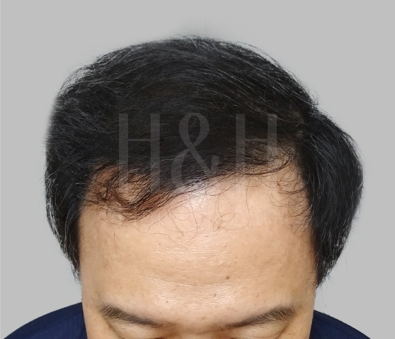 頭髮稀疏_植髮手術見證案例_HH醫髮4