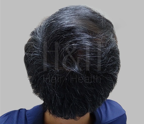 頭髮稀疏_植髮手術見證案例_HH醫髮2