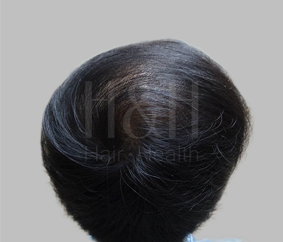 頭髮稀疏_植髮手術見證案例_HH醫髮6