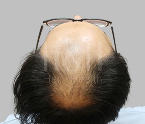 頭髮稀疏_植髮手術見證案例_HH醫髮5