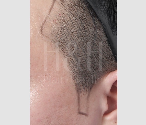 美型植髮_鬢角案例_H&H醫髮診所