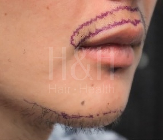 植鬍手術案例_H&H醫髮診所
