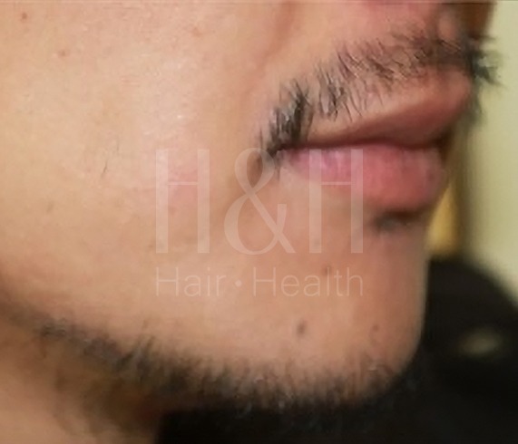 植鬍手術案例_H&H醫髮診所