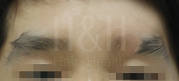 植眉手術案例_H&H醫髮診所