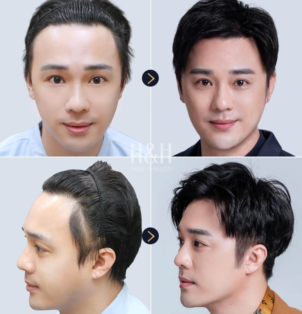韓系美型植髮前後比較_H&H