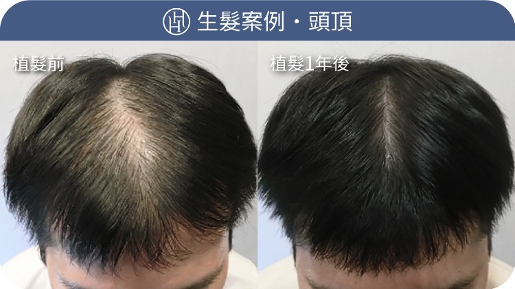 生髮案例-HH醫髮診所 生髮案例-HH醫髮診所