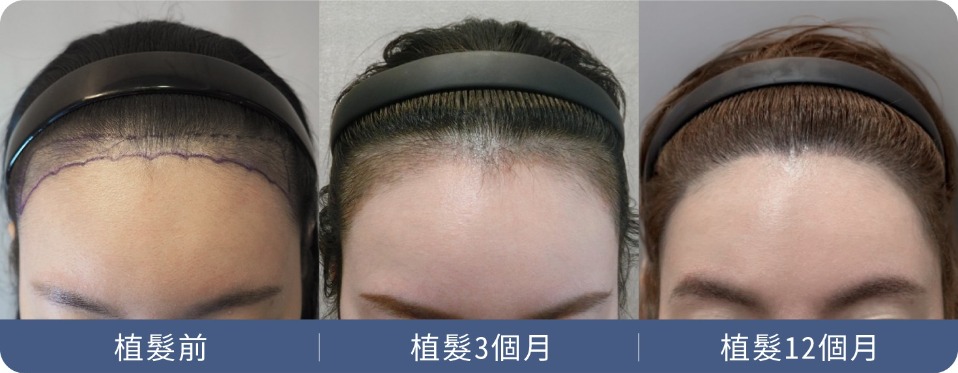 美型植髮案例-HH醫髮診所 美型植髮案例-HH醫髮診所