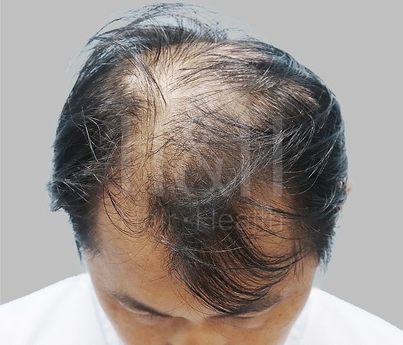 台北植髮,新竹植髮,台中植髮-素人案例植髮前-H&H醫髮診所