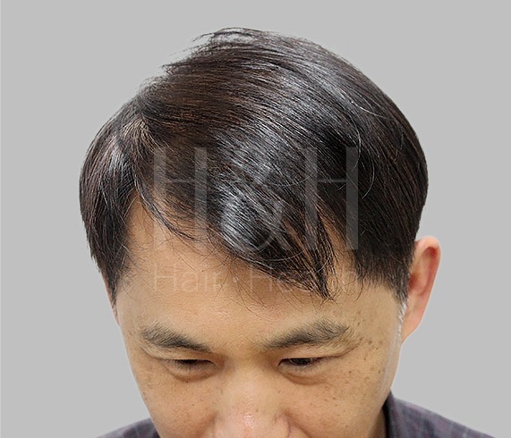 台北植髮,新竹植髮,台中植髮-素人案例植髮後-H&H醫髮診所