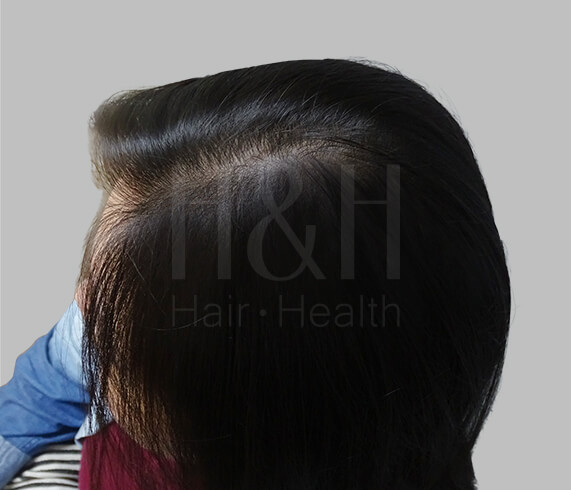 增加髮量,H&H醫髮診所