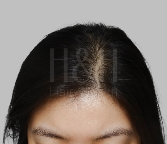 生髮療程案例,H&H醫髮診所
