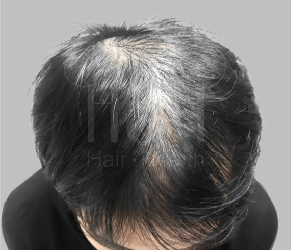 落髮治療_術前案例_H&H醫髮