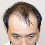 台北植髮,新竹植髮,台中植髮推薦-掉髮影響日常生活-H&H醫髮診所