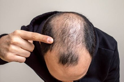 雄性禿治療_治療方法_H&H醫髮