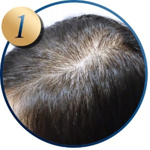 雄性禿治療_分線距離_H&H醫髮