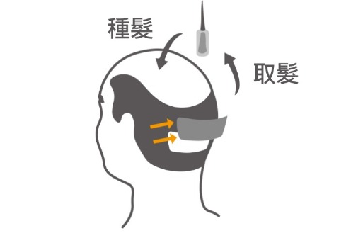 植髮原理_種髮取髮_H&H醫髮