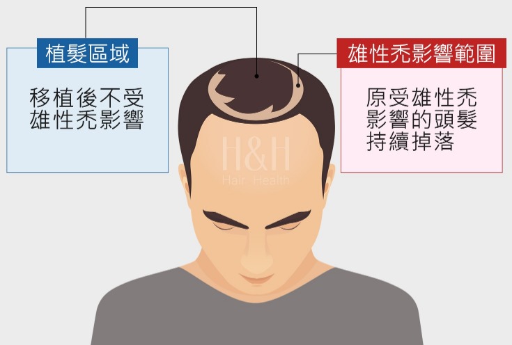 台北植髮,新竹植髮,台中植髮-誰不適合做植髮-H&H醫髮診所