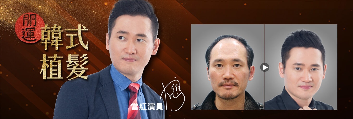 開運髮型_藝人案例_H&H醫髮