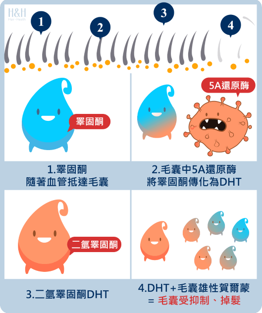 雄性禿真的無髮可救 掌握關鍵改善 禿頭 H H 醫髮診所
