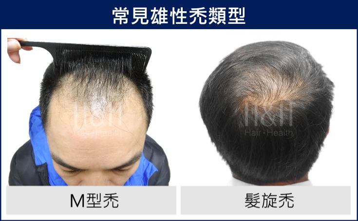 禿頭前兆是雄性禿還是髮旋禿 禿頭門診 7大階段治療對症下藥 禿頭前兆是雄性禿還是髮旋禿 禿頭門診 7大階段治療對症下藥