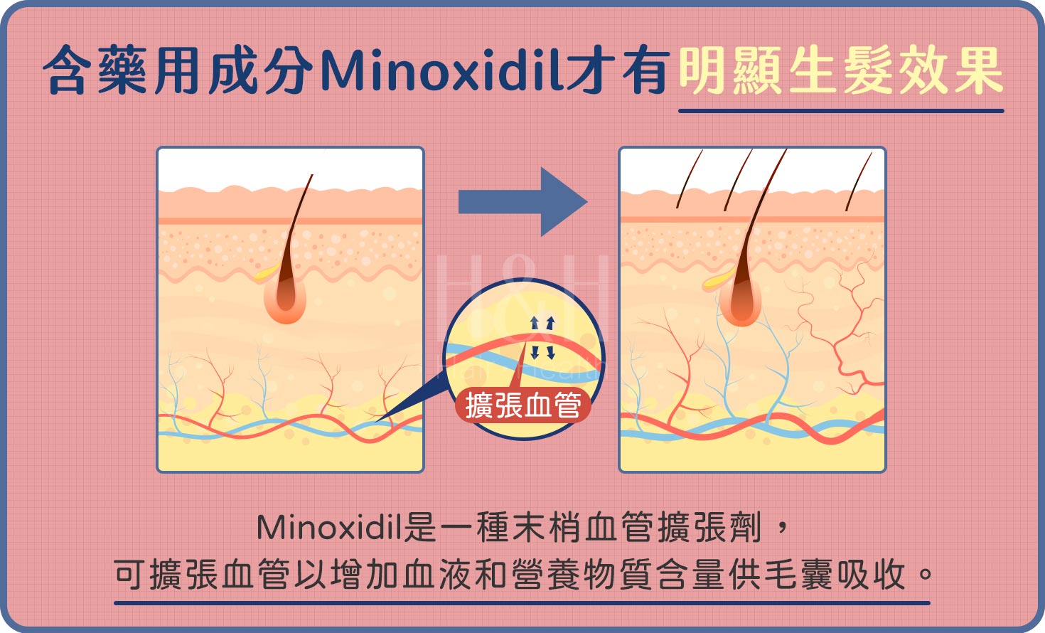 生髮水_女用生髮水的作用原理是什麼_H&H醫髮