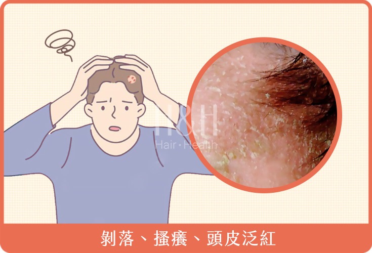 脂漏性皮膚炎-脂漏性皮膚炎常見症狀-H&H
