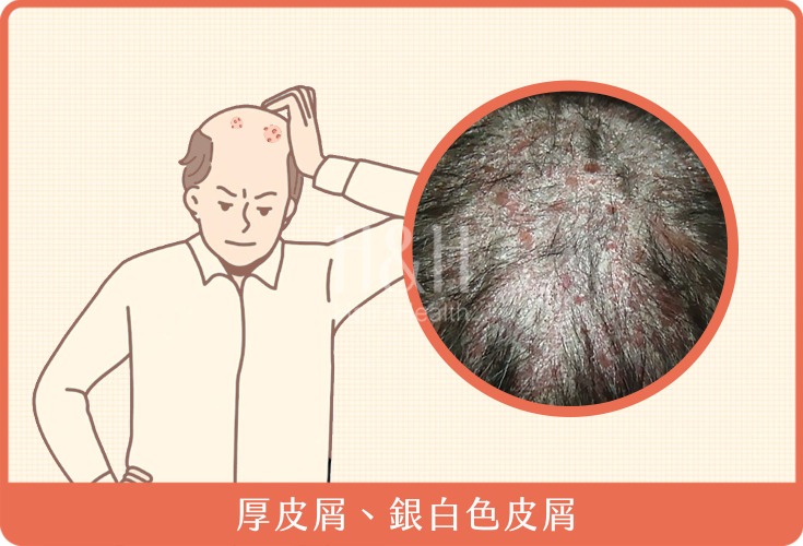 頭皮乾癬常見症狀-H&H