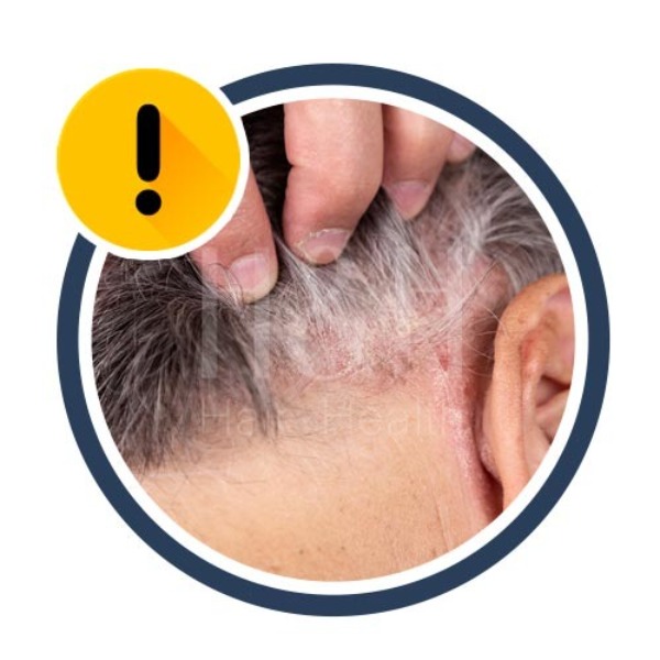 毛囊萎縮-毛囊發炎好發對象4：頭皮容易過敏者-H&H