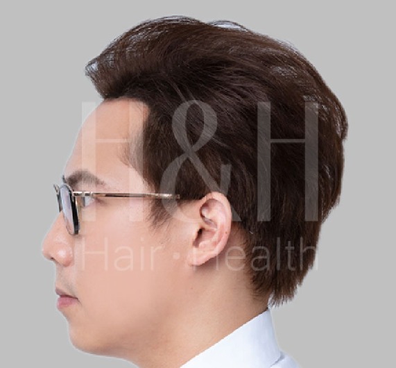 台中植髮-男性植髮術後照-H&H醫髮診所
