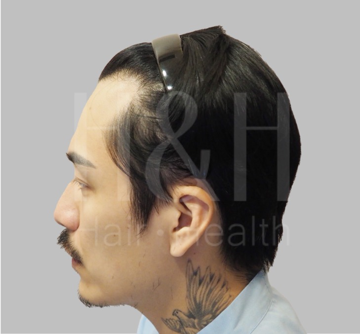 台中植髮-男性植髮術前照-H&H醫髮診所