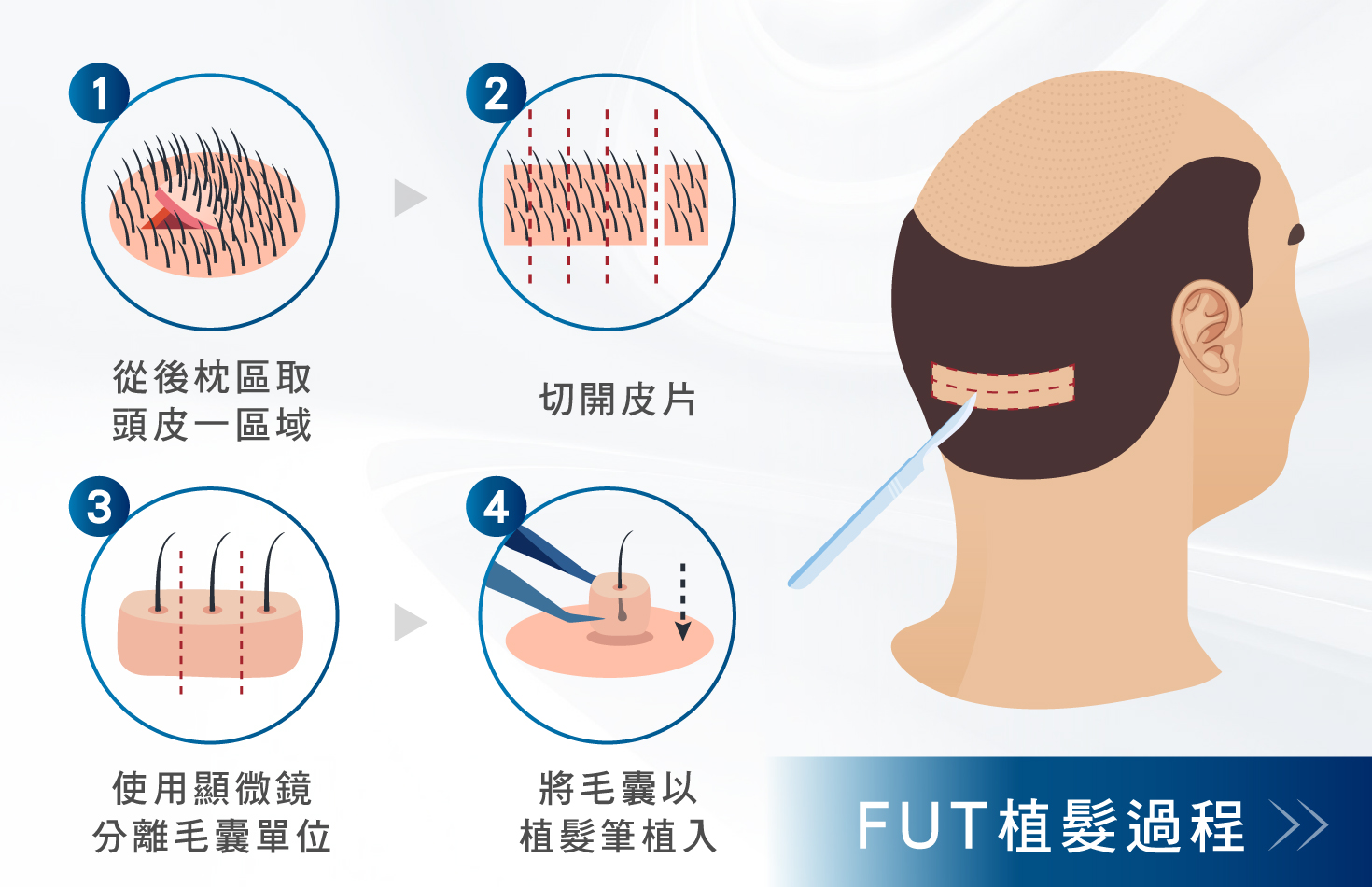 FUT植髮是什麼？-FUT植髮過程-H&H醫髮診所