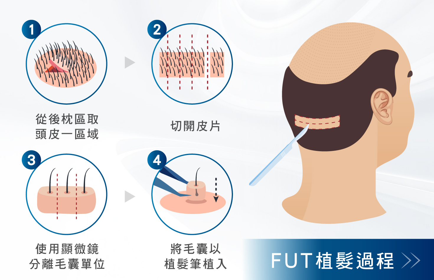 FUT植髮是什麼？-FUT植髮過程-H&H