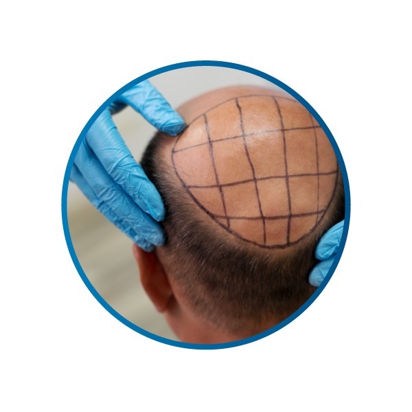 植髮4大適應對象-遺傳性雄性禿患者-H&H