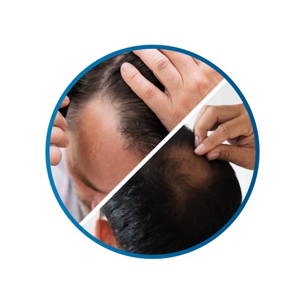 植髮4大適應對象-髮際線後退、頭頂稀疏者-H&H