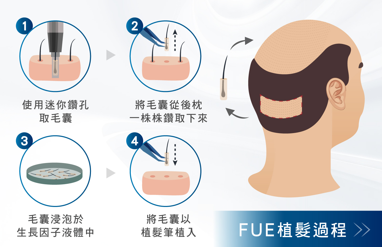 FUE植髮是什麼？-FUE植髮過程-H&H醫髮診所