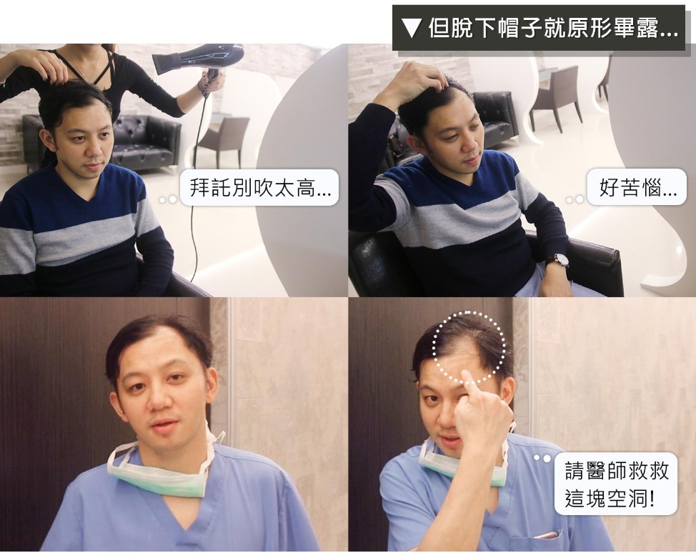 M型禿-劉賢佐醫師植髮前-HH醫髮診所