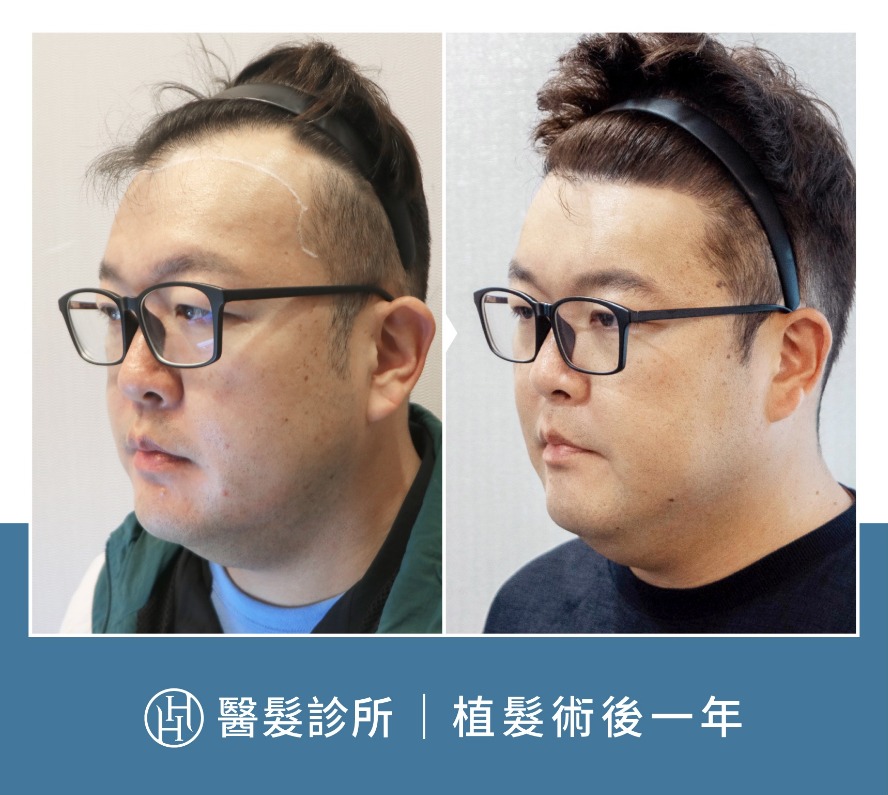 植髮案例-百萬訂閱YouTuber「志銘」植髮案例分享-HH醫髮診所