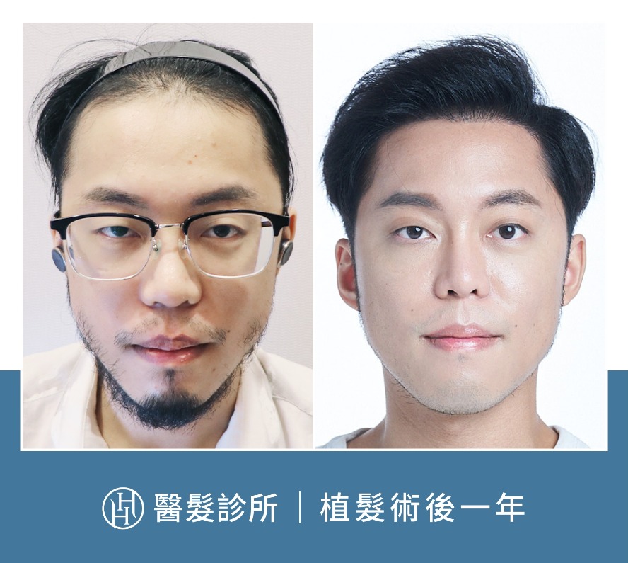 植髮案例-百萬訂閱YouTuber「超粒方」植髮案例分享-HH醫髮診所
