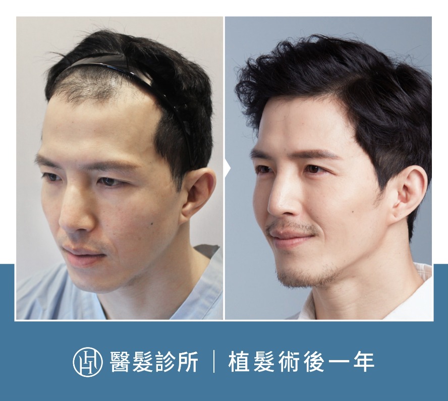 植髮案例-男演員兼拳擊手「邱紹元」植髮手術案例分享-HH醫髮診所